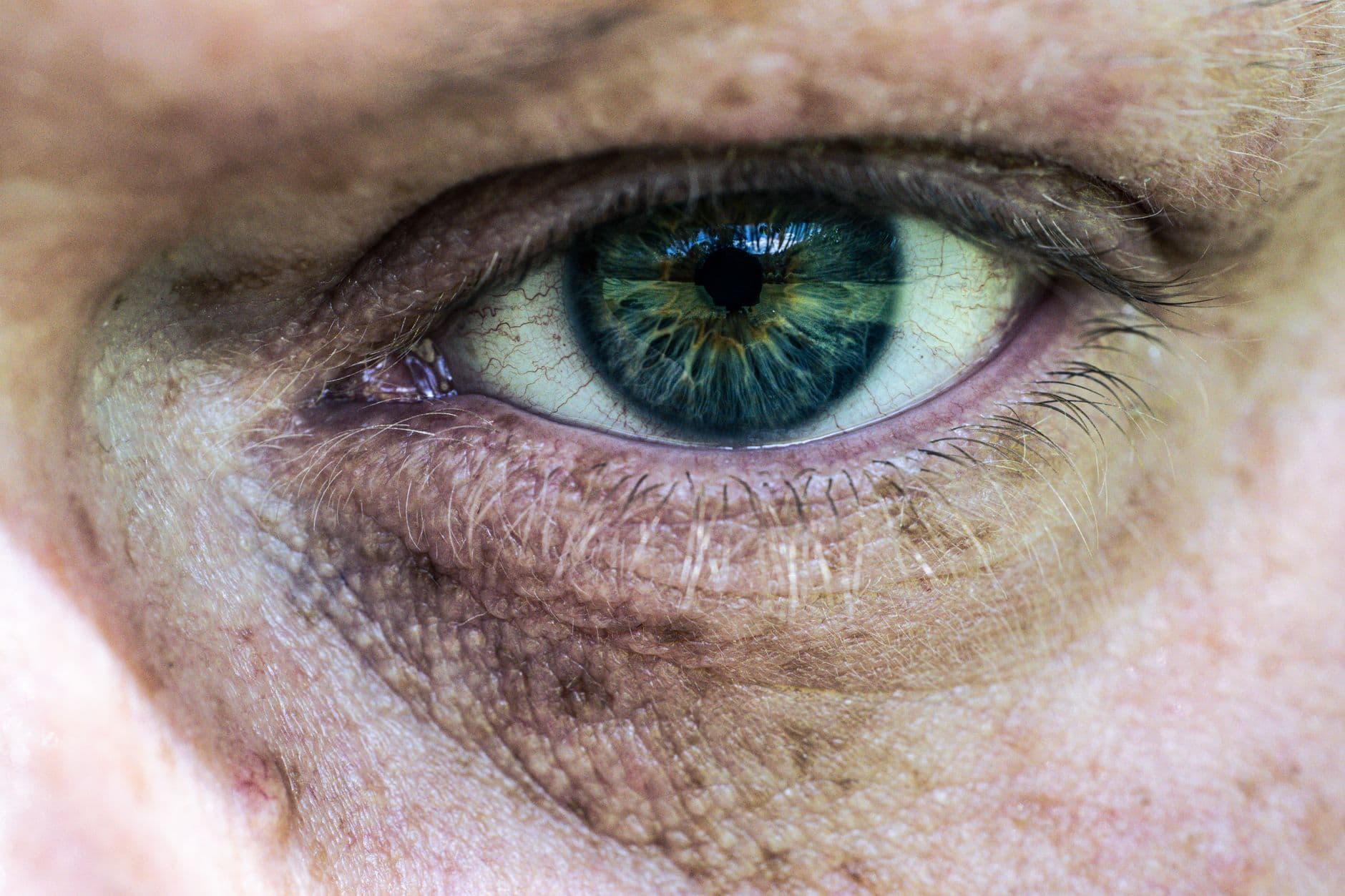Eyelid Surgery: What to Expect